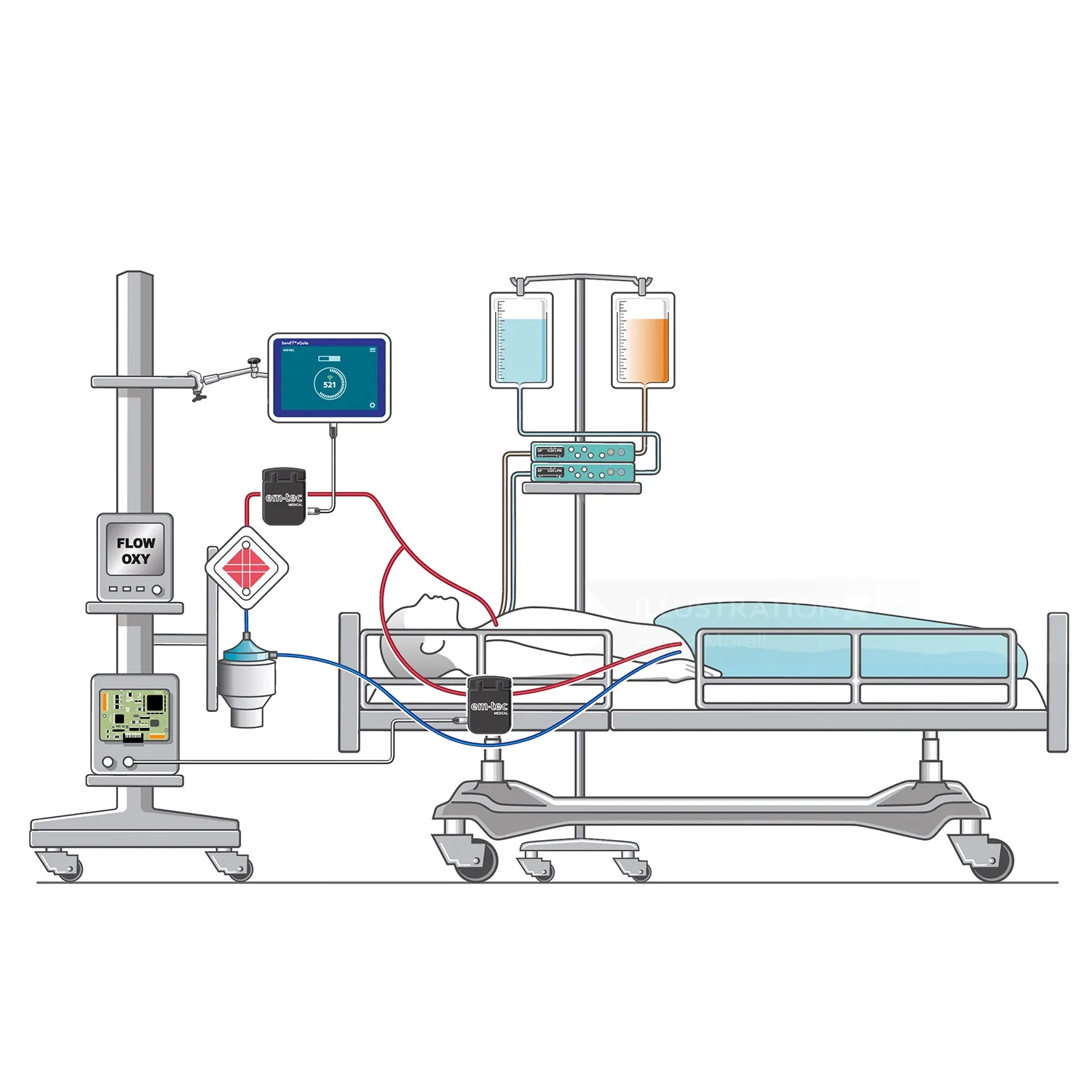 Hospital bed surrounded by medical equipment and infusion pumps