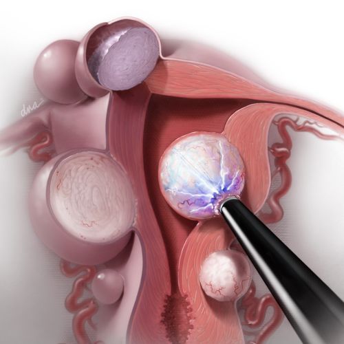 Radiofrequency Ablation of Uterine Fibroids