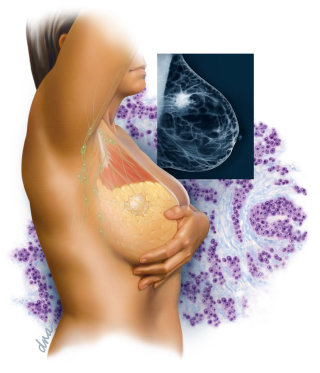Patiente atteinte d&#39;un cancer du sein avec mammographie