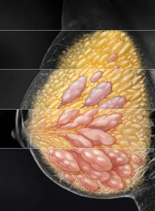 Natural image on 4 grades of breast density in mammography