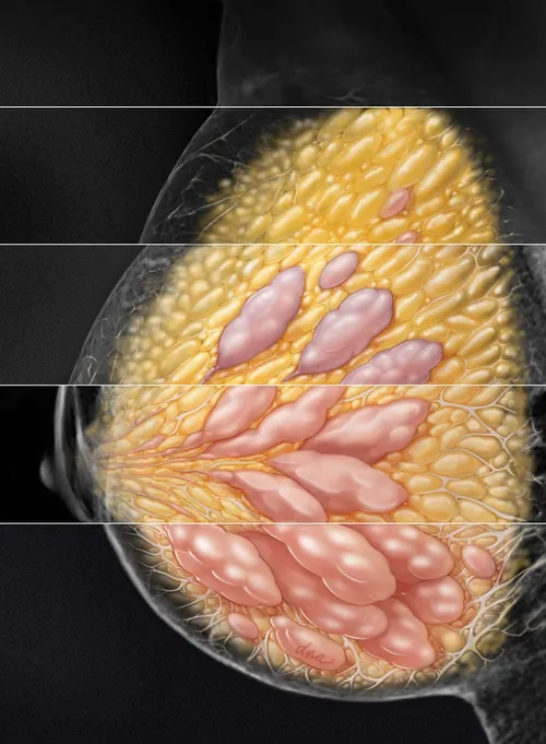 Natural image on 4 grades of breast density in mammography