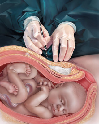 Ilustración de cirugía de cesárea para revista médica