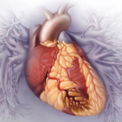 Coronary Artery Disease photorealism