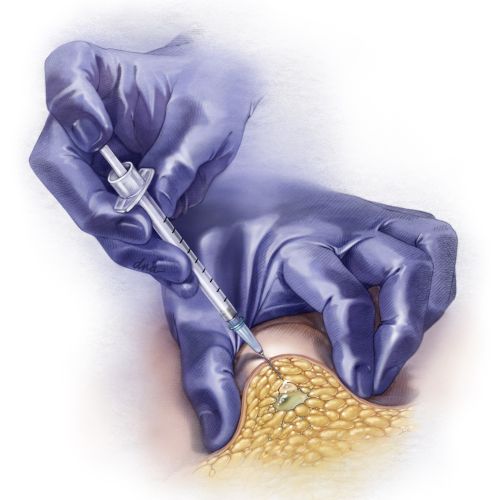 A realistic illustration of the subcutaneous injection method