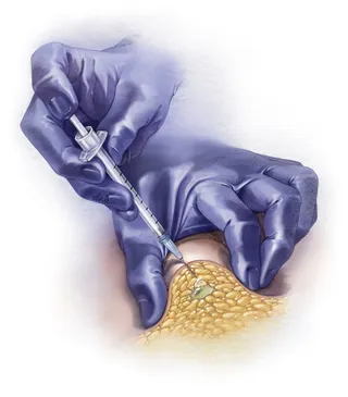 A realistic illustration of the subcutaneous injection method