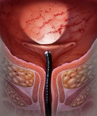 膀胱痛症候群のデジタルアート