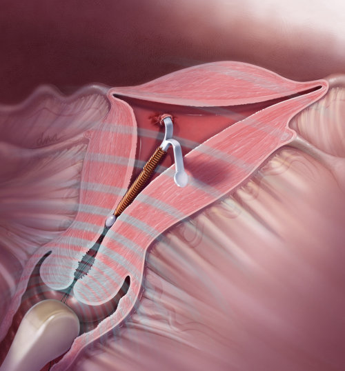 Removal of Embedded IUD