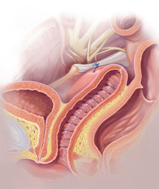 Ilustração pós-operatória mostrando a fixação do ligamento sacroespinhoso