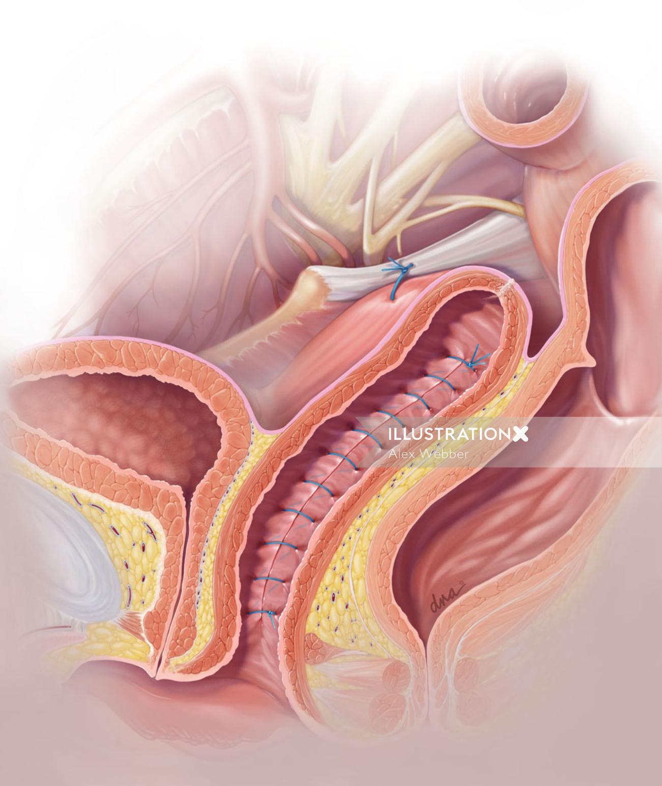 Ilustração pós-operatória mostrando a fixação do ligamento sacroespinhoso