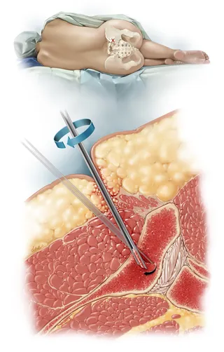 Bone marrow collection for biopsy sample