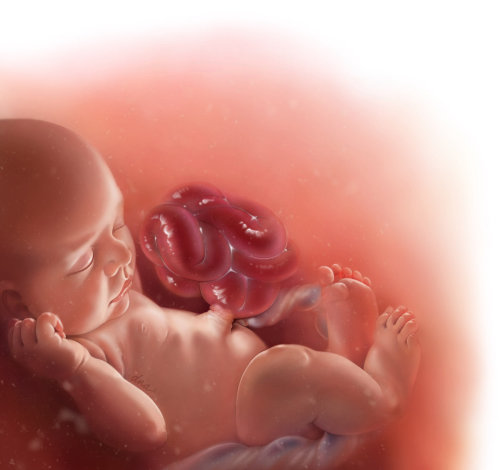 Realistic illustration of gastroschisis with some inflammation of the midgut