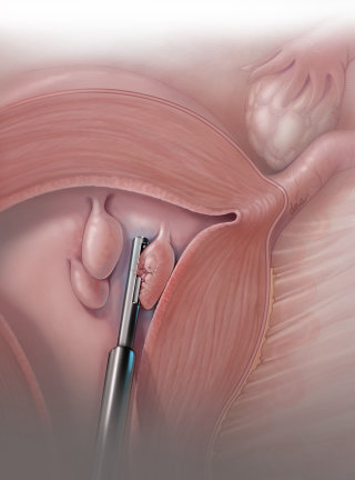 ポリープ除去のための子宮鏡検査のイラスト