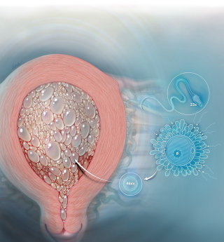 葡萄胎妊娠写实插画