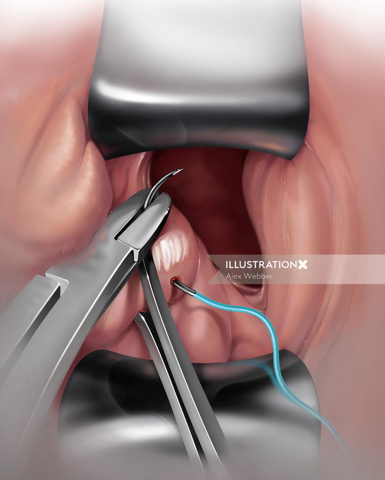 Ilustração médica de lesão iatrogênica