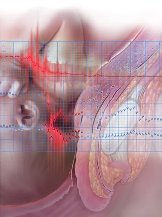 Amniotic fluid embolism for Contemporary OBGYN Magazine