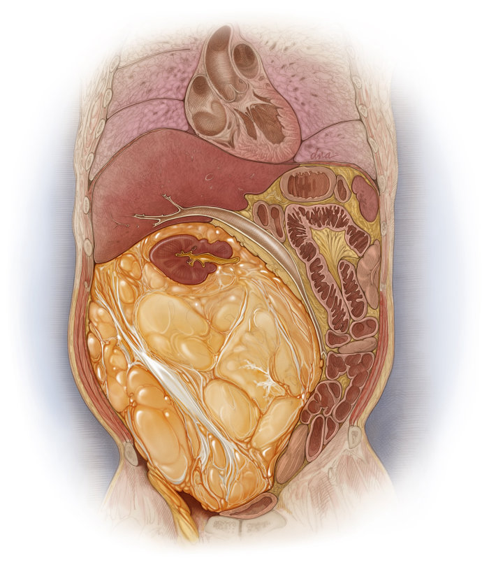 脂肪肉腫に関するJADPROの表紙用に作成されたエディトリアル画像