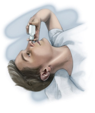Ilustración educativa sobre cómo utilizar el aerosol nasal.