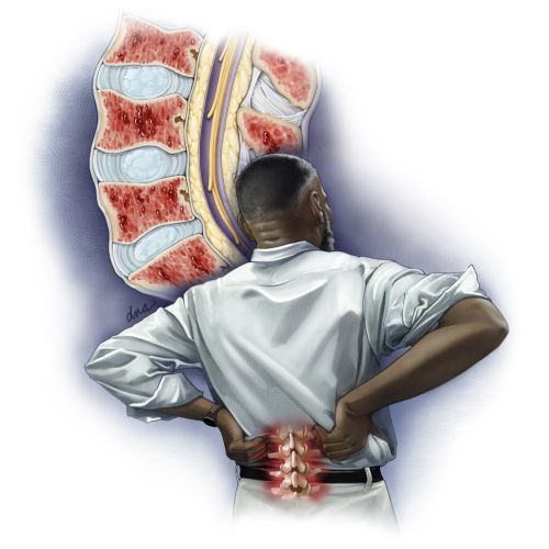 Medical illustration about multiple myeloma patient with back pain