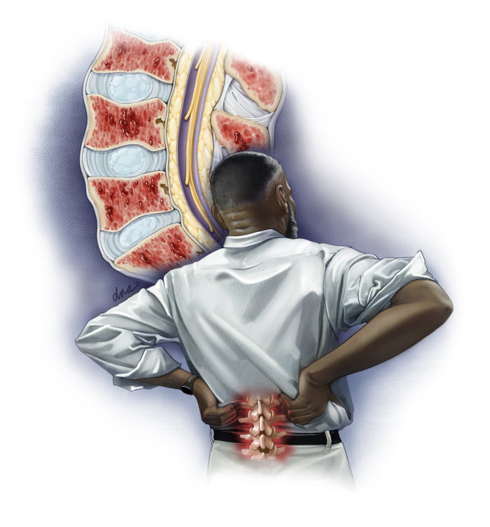 Illustration médicale sur un patient atteint de myélome multiple souffrant de maux de dos
