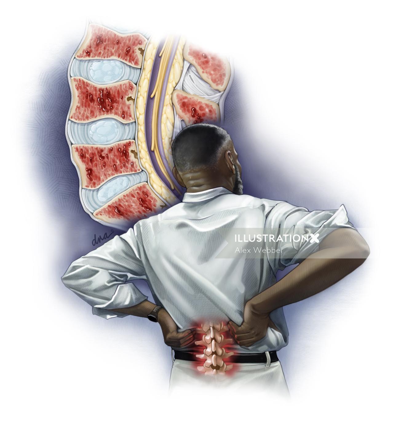 Ilustração médica sobre paciente com mieloma múltiplo com dor nas costas