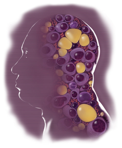 Illustration about multiple myeloma for an article