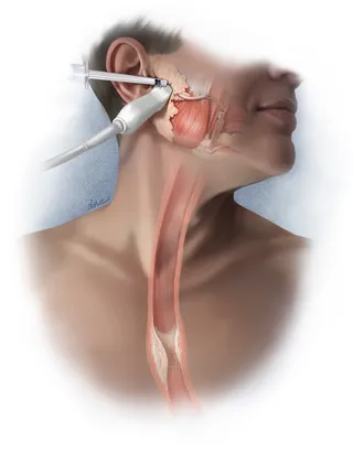 Botulinum injection for esophageal cancer