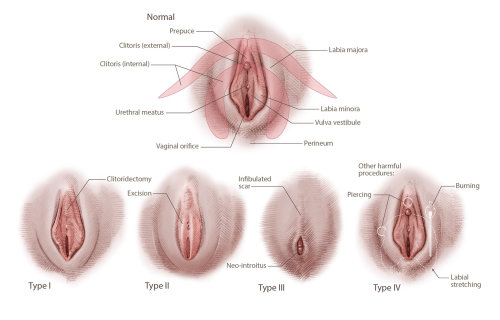 Realistic illustration of female genital mutilation