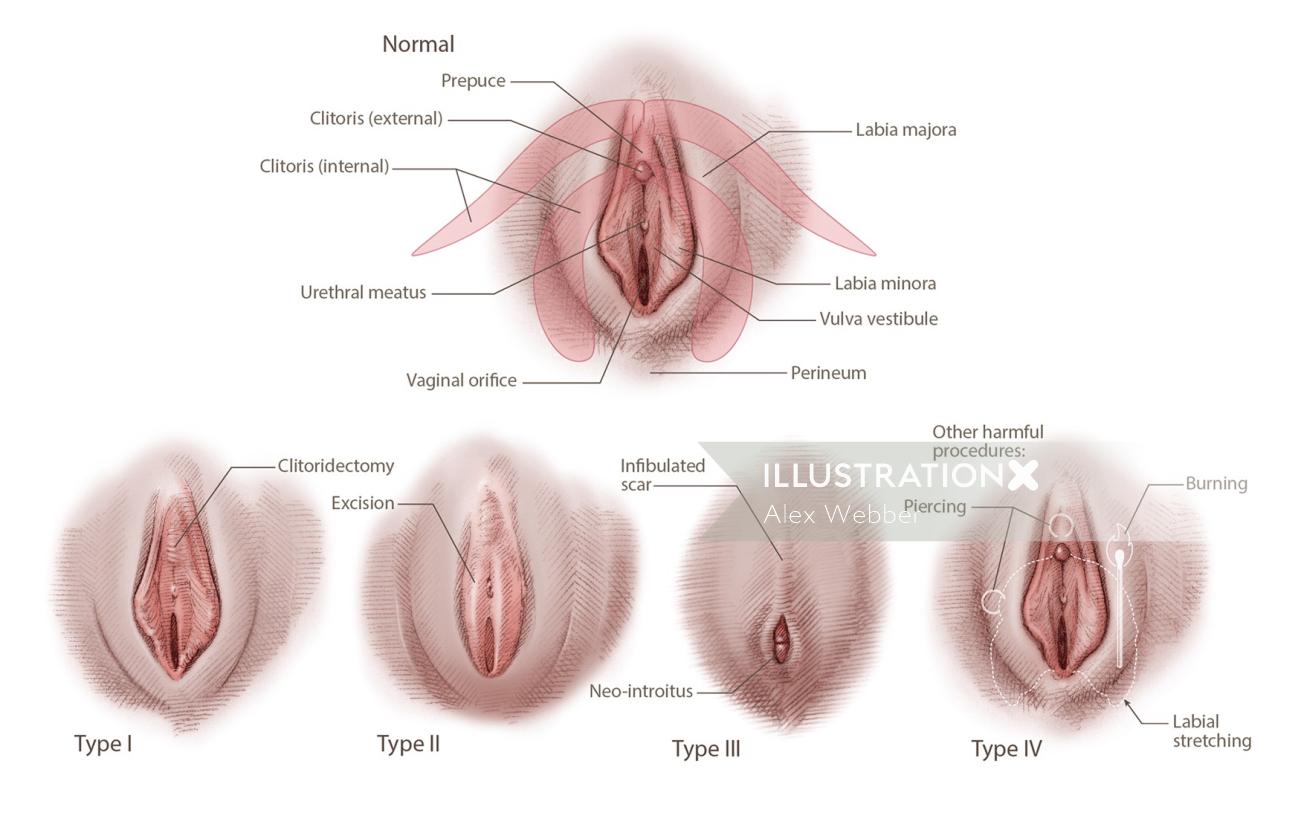 女性器切除のリアルなイラスト