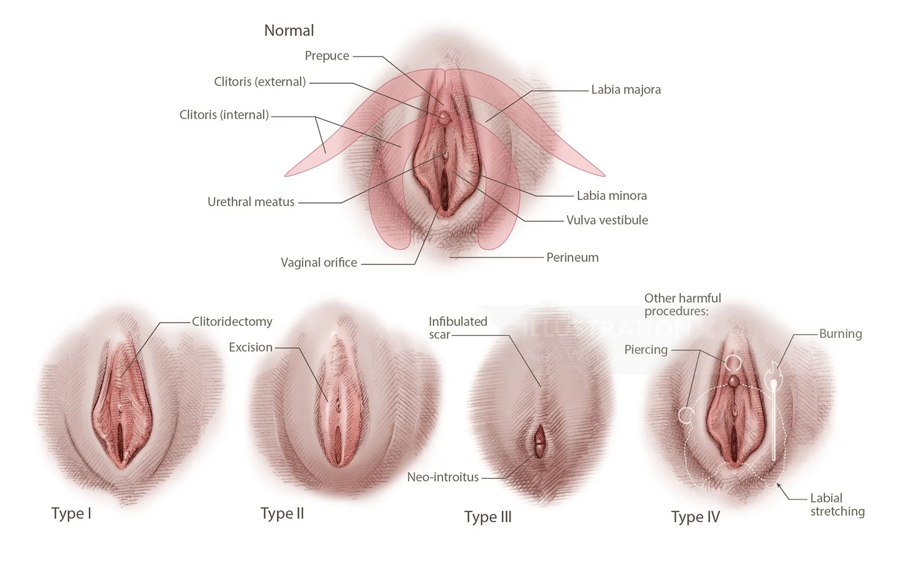 Realistic illustration of female genital mutilation