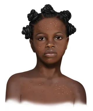 Portrait of young Black girl with bantu knots and visible skin condition by Alex Webber