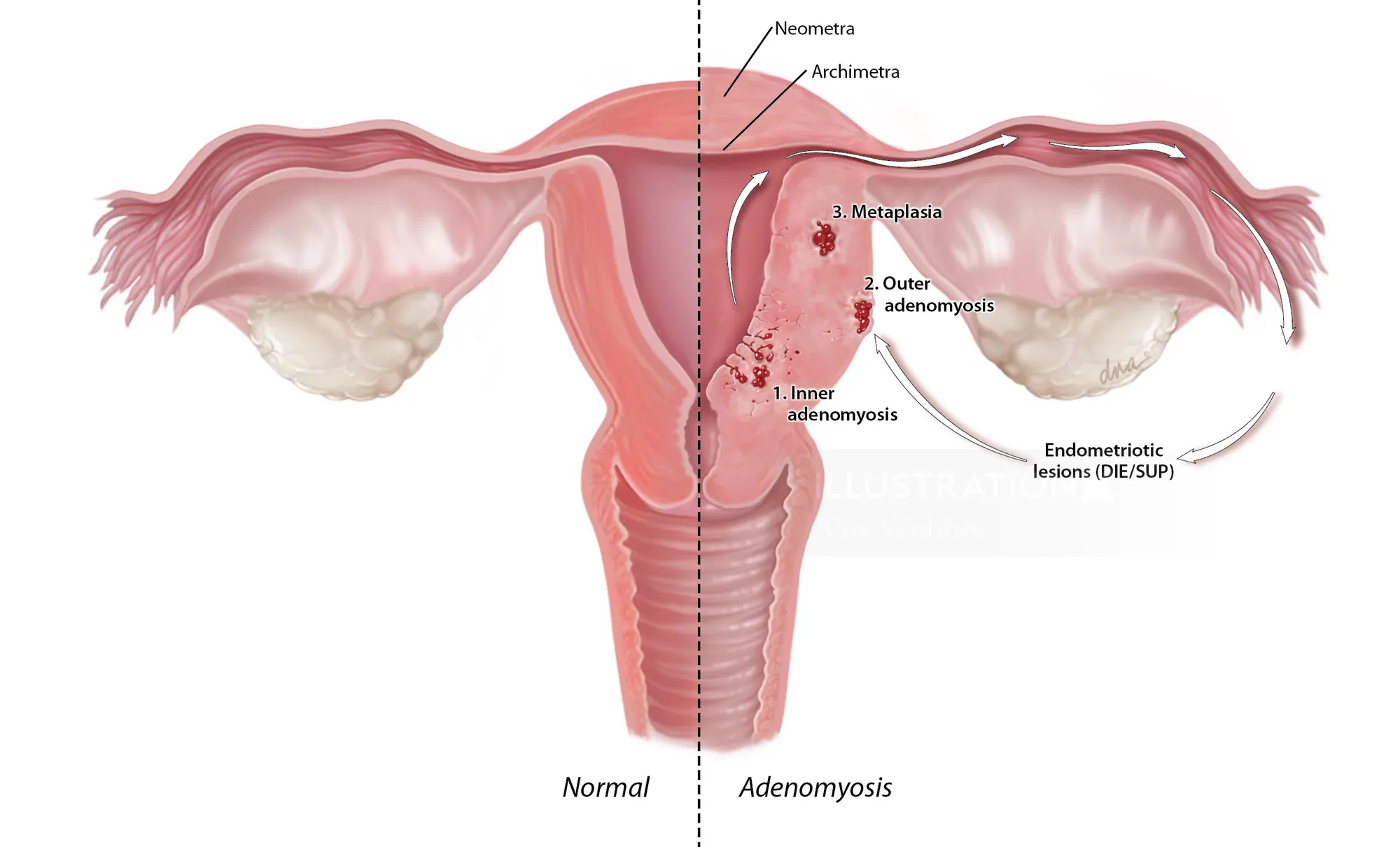 Medical illustration of normal uterus and adenomyosis by Alex Webber