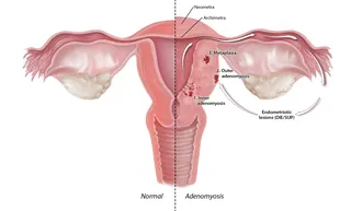 Medical illustration of normal uterus and adenomyosis by Alex Webber