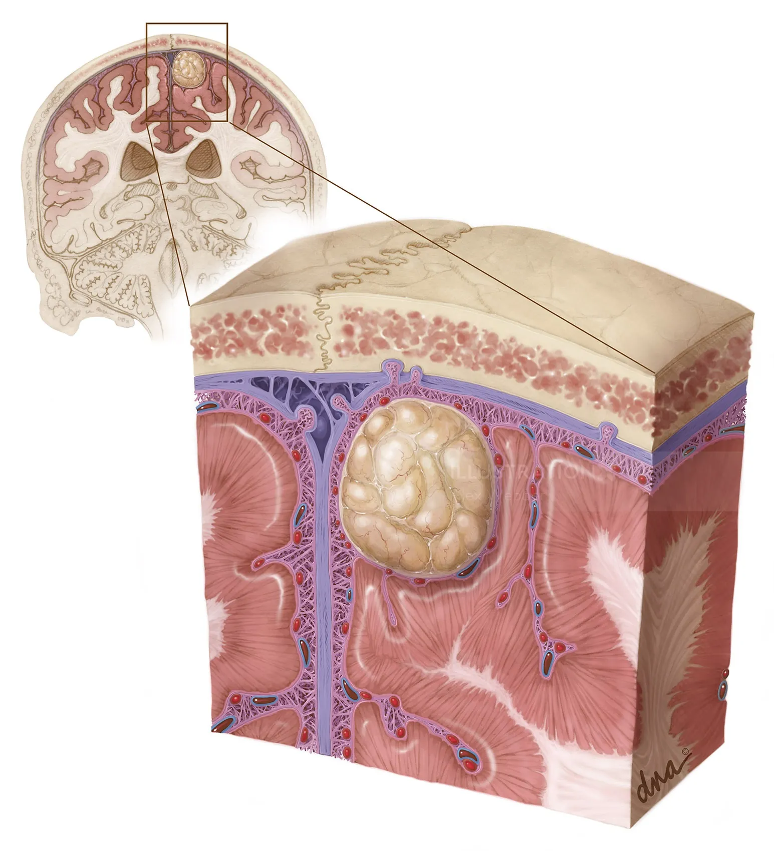 Cross-sectional human skin with tumor growth, illustration by Alex Webber
