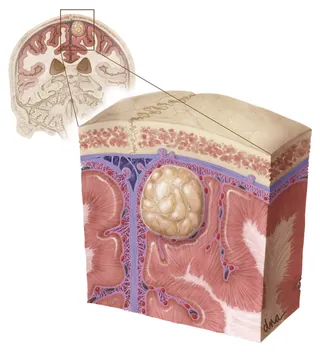 Cross-sectional human skin with tumor growth, illustration by Alex Webber