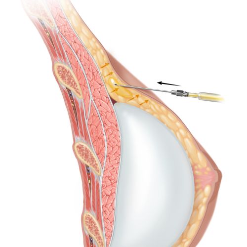 Cross-section of breast injection procedure showing needle and tissue layers by Alex Webber