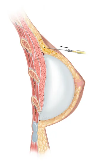 Cross-section of breast injection procedure showing needle and tissue layers by Alex Webber