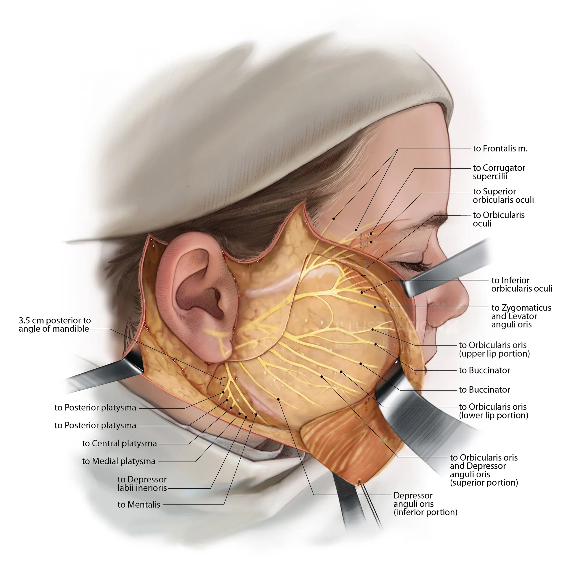 Facial nerve anatomy illustration showing labeled muscles and nerve branches by Alex Webber