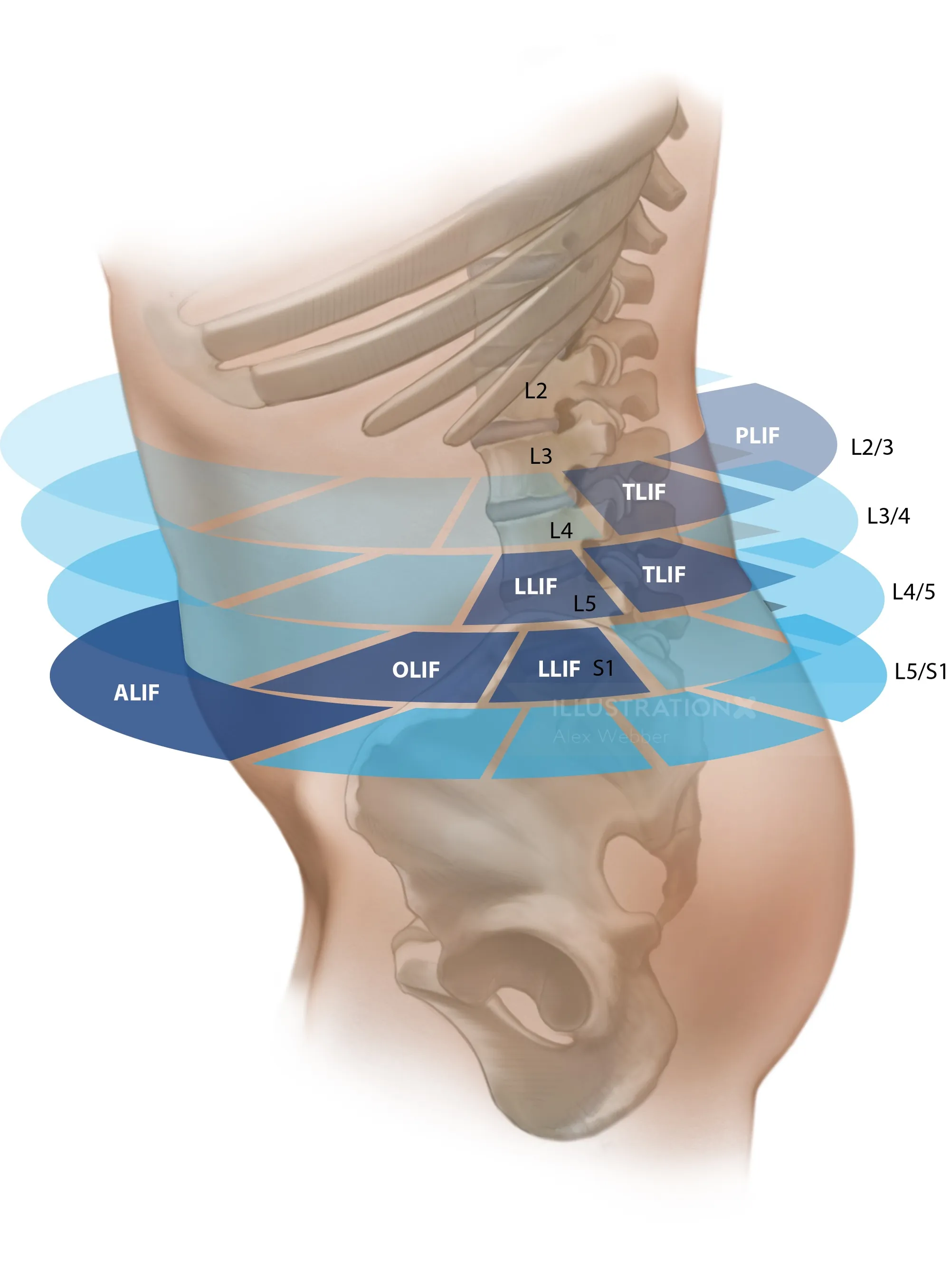 Lumbar spine anatomy showing ligaments and vertebrae levels by Alex Webber