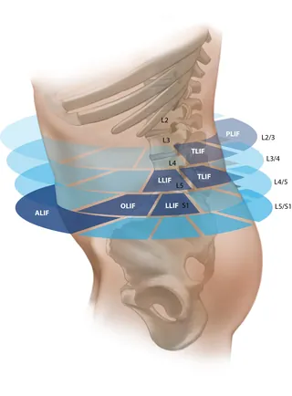 Lumbar spine anatomy showing ligaments and vertebrae levels by Alex Webber