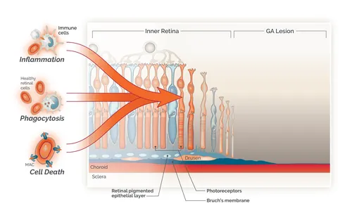 Diagram of retinal layers affected by GA lesion showing inflammation and cell death, by Alex Webber
