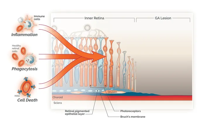 Diagram of retinal layers affected by GA lesion showing inflammation and cell death, by Alex Webber