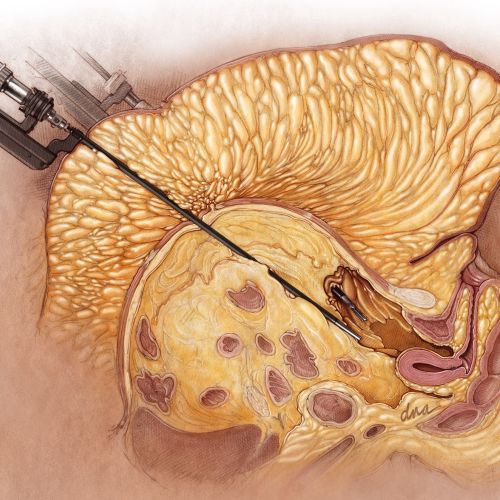 Brain biopsy procedure medical illustration by Alex Webber