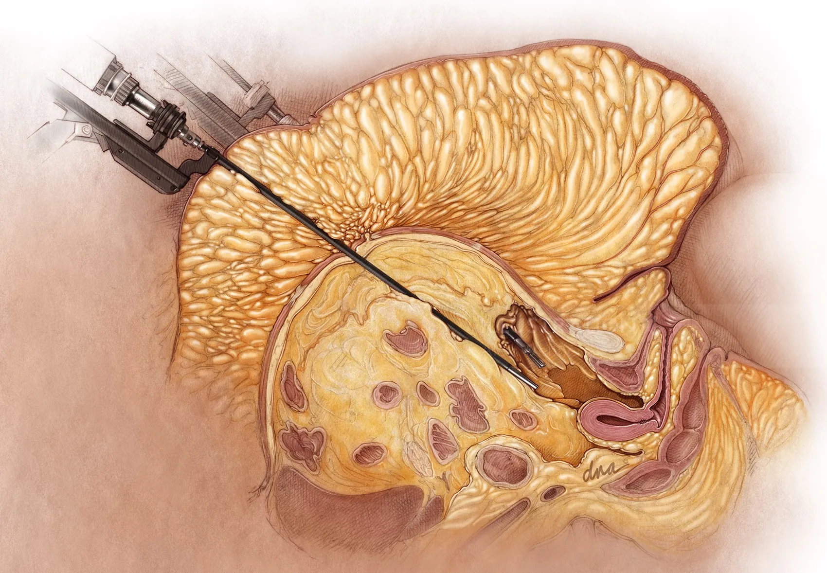 Brain biopsy procedure medical illustration by Alex Webber