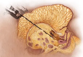 Brain biopsy procedure medical illustration by Alex Webber