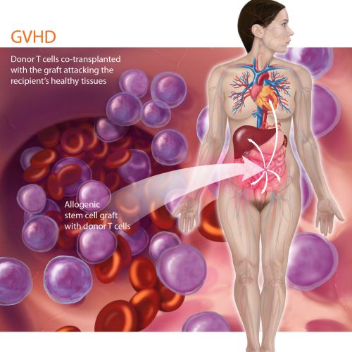 GVHD immune response showing donor T cells attacking recipient tissues by Alex Webber