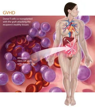 GVHD immune response showing donor T cells attacking recipient tissues by Alex Webber