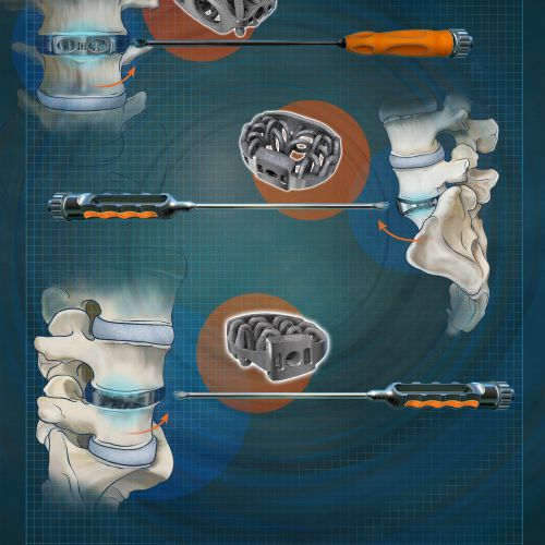 Medical illustration of lumbar spine surgery instruments by Alex Webber