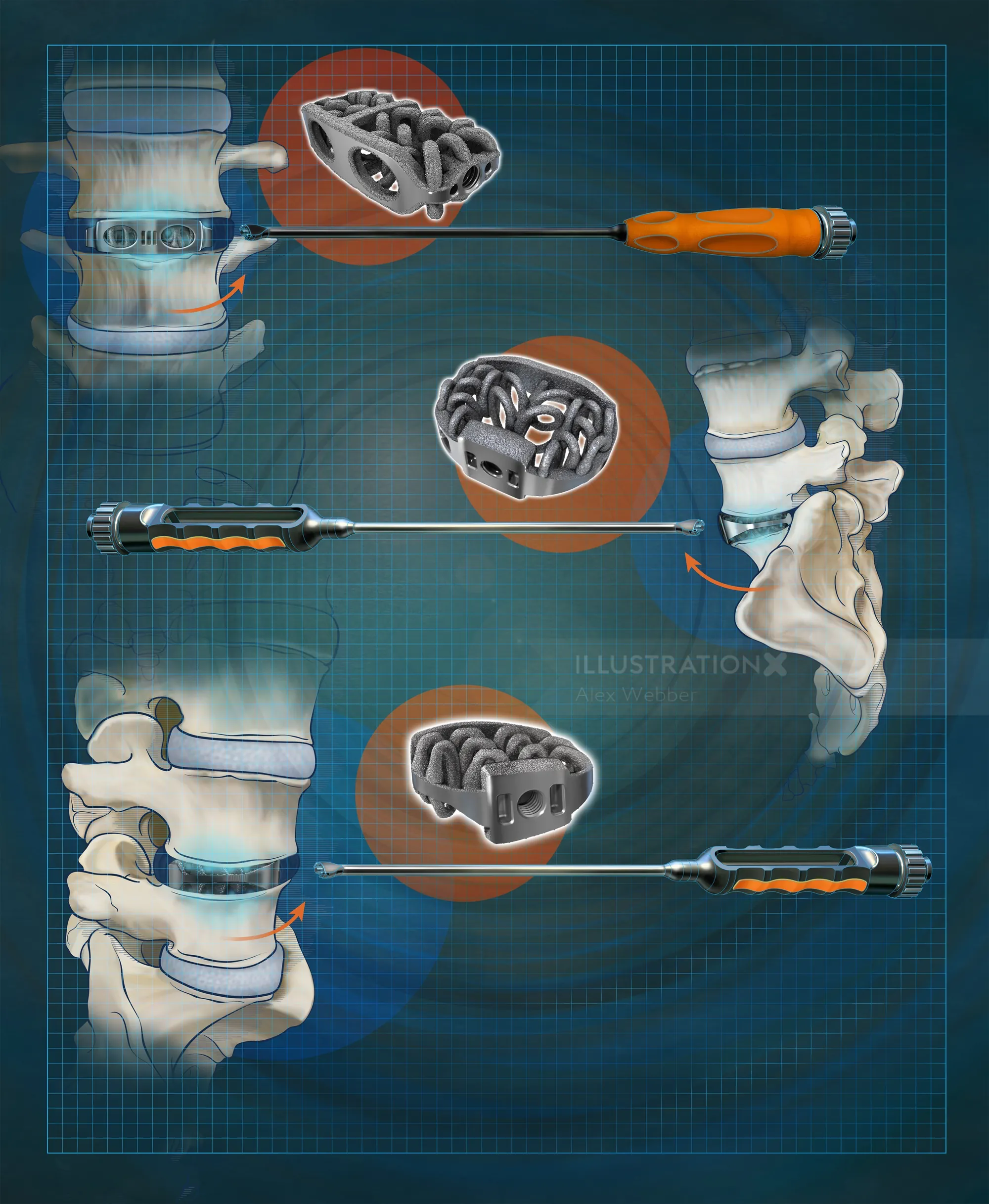 Medical illustration of lumbar spine surgery instruments by Alex Webber