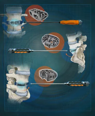 Medical illustration of lumbar spine surgery instruments by Alex Webber