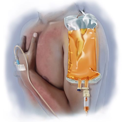 Human arm receiving IV fluid through medical tubing